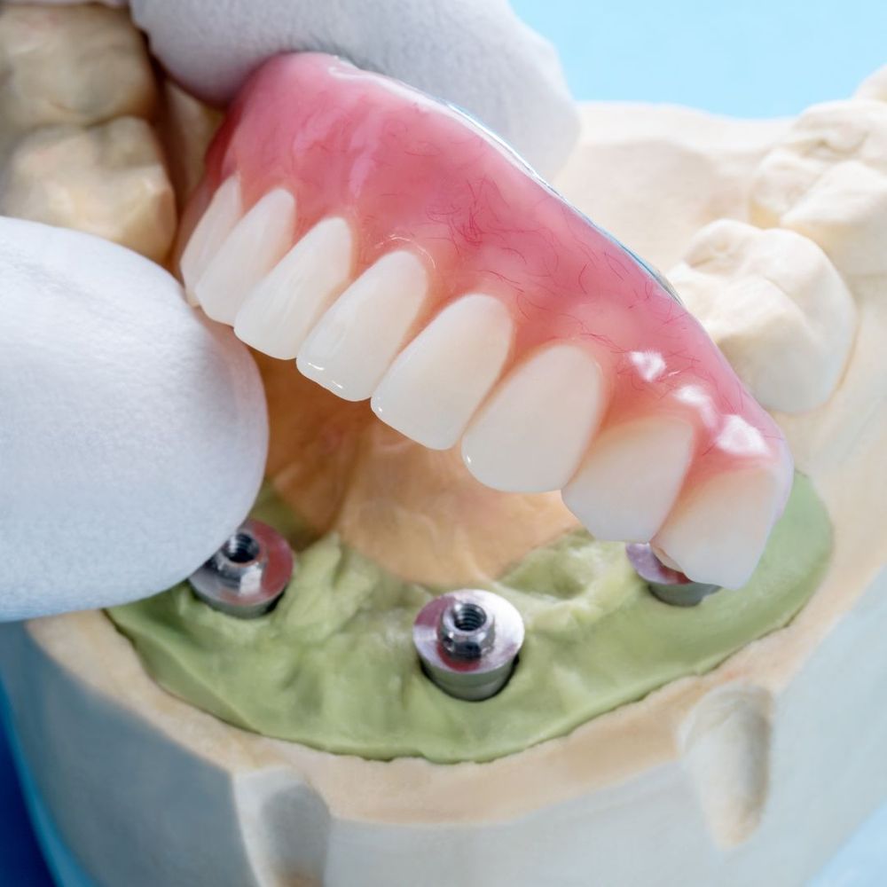 dental implant