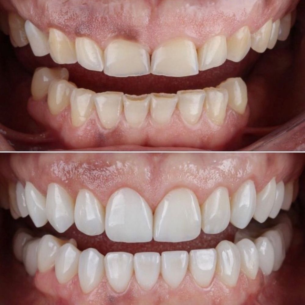 HowLongDoVeneersLast-4.jpg