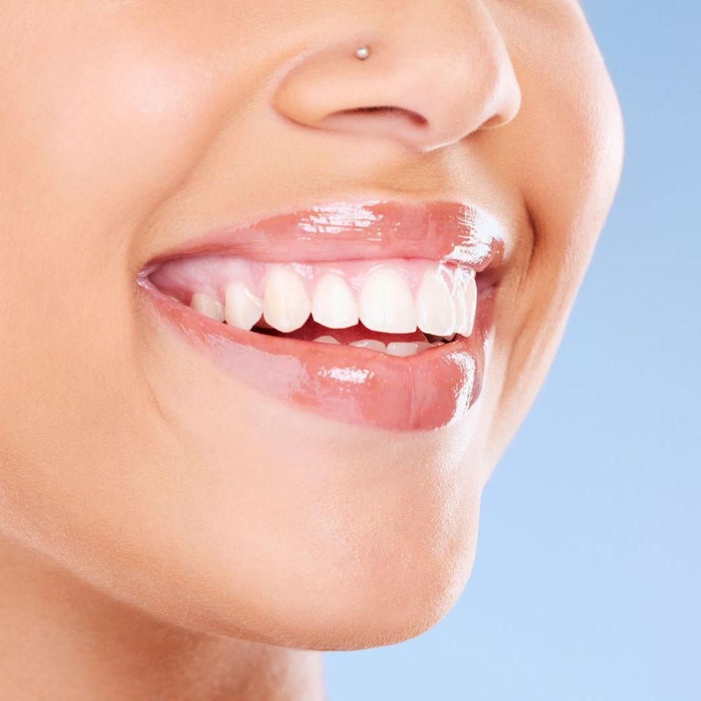 smiling with dental veneers