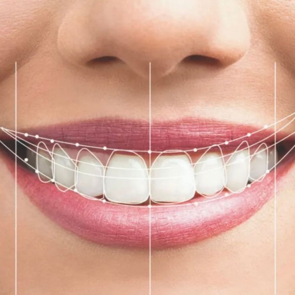 dental veneer consultation