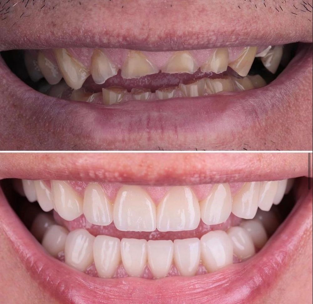 full mouth reconstruction 3.jpg