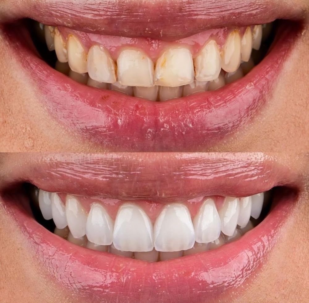 full mouth reconstruction2.jpg