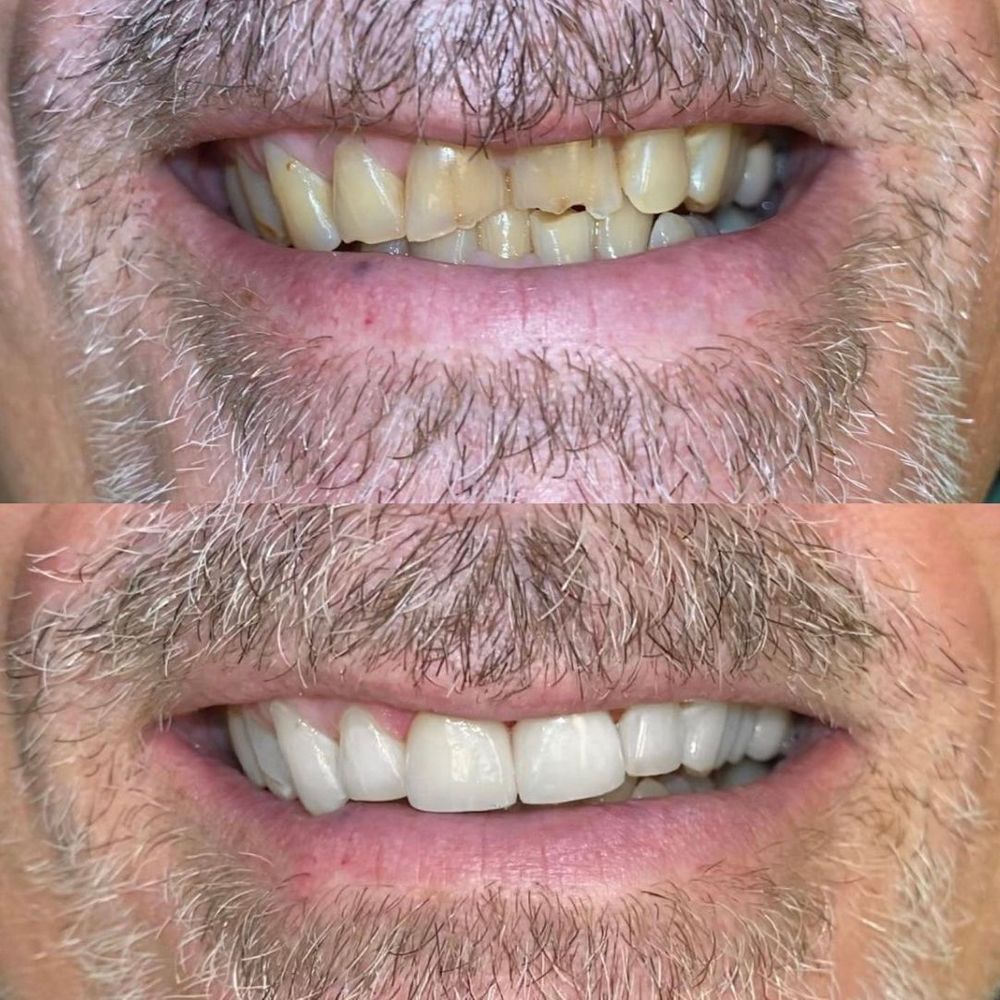 Mouth Rehabilitation How to Choose the Right Treatment - Imagw 1.jpg