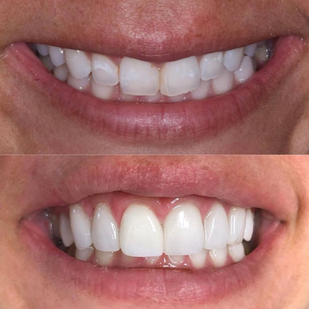 before and after mouth rehabilitation