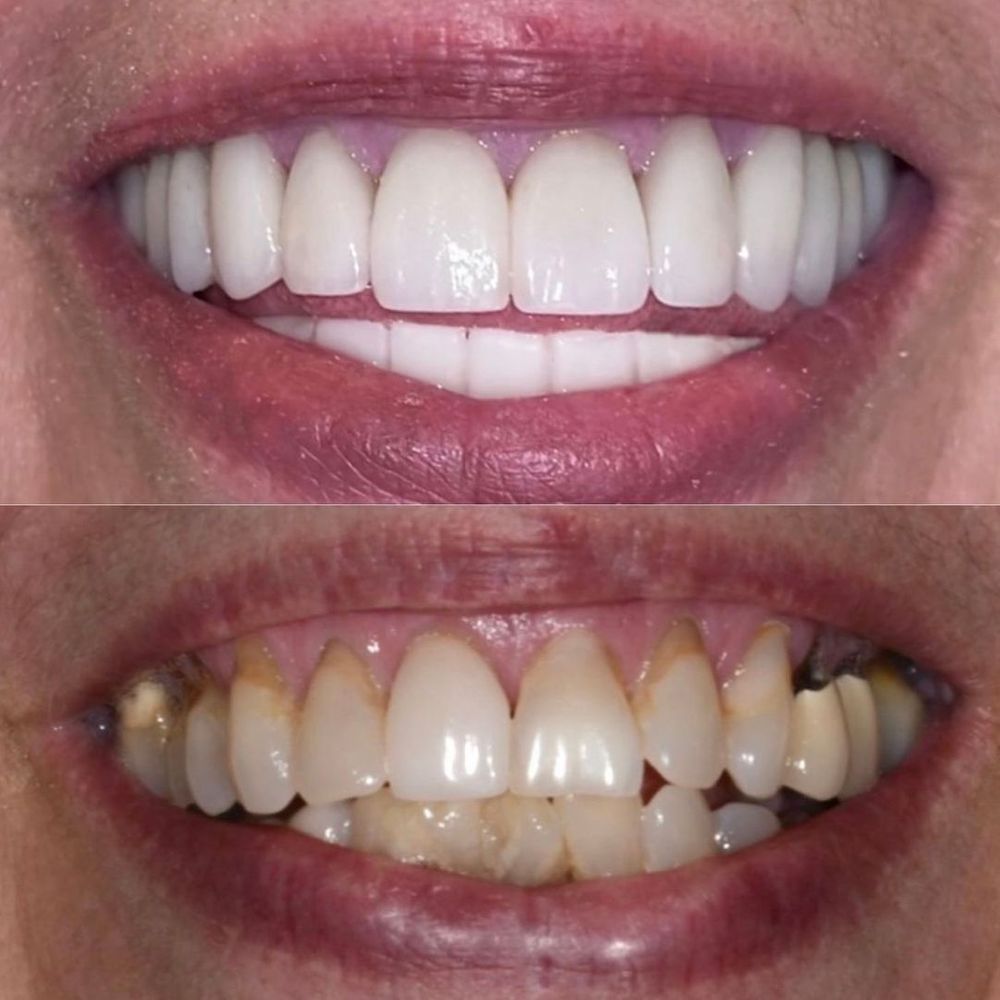 Before and after pictures of mouth rehabilitation.