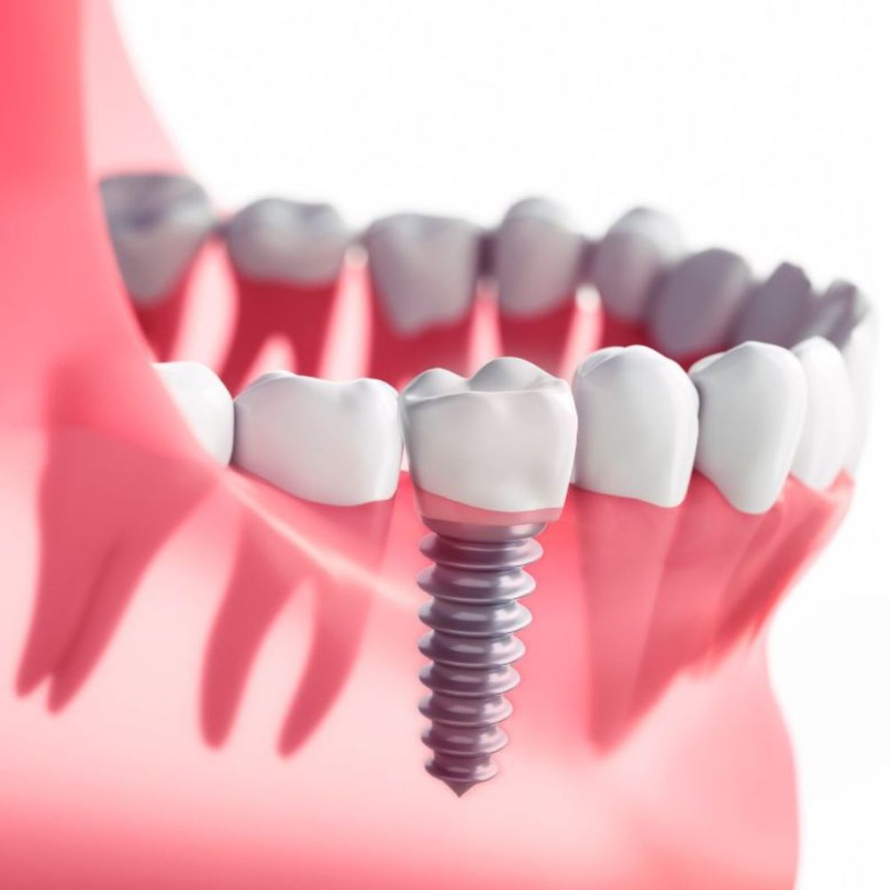 3D model of dental implant