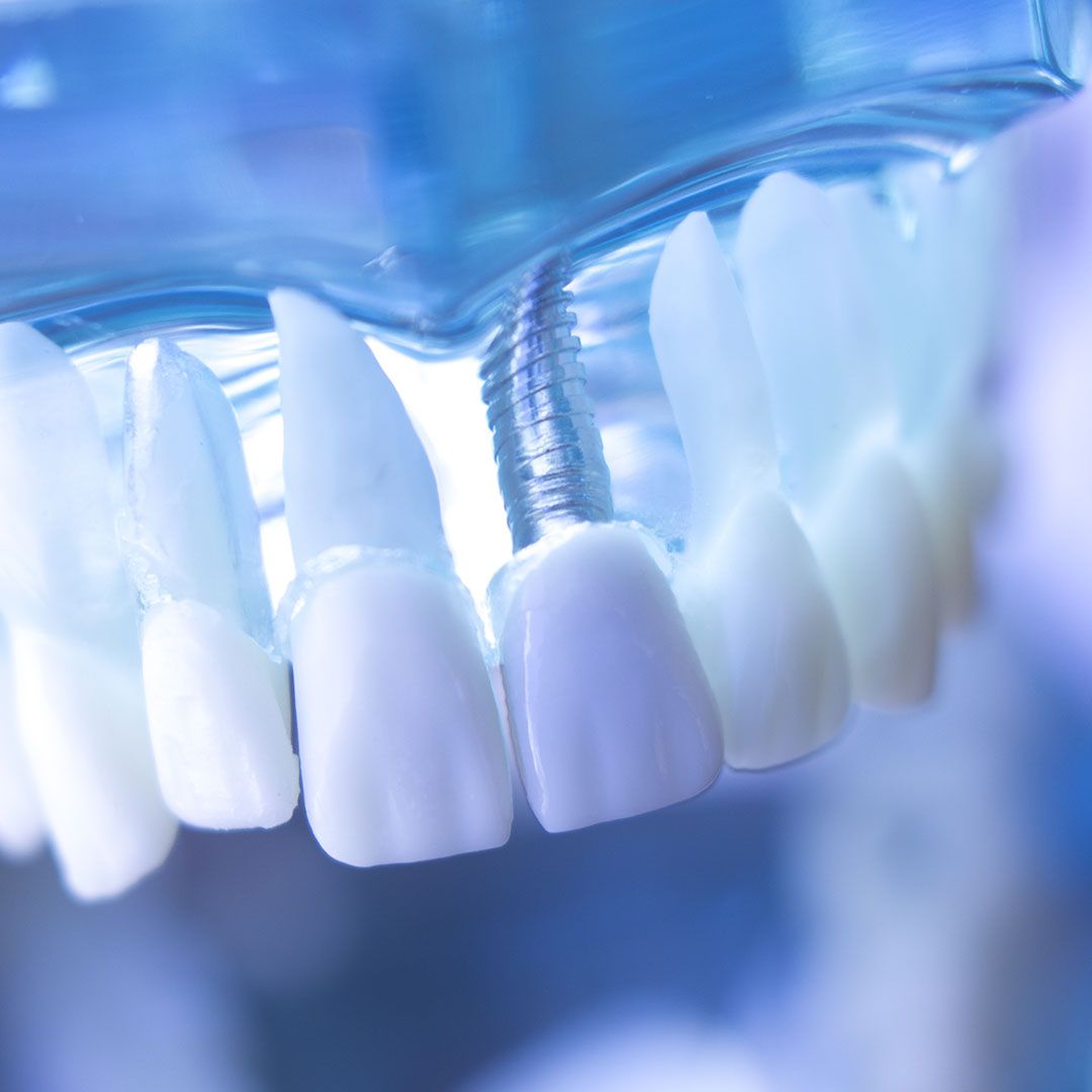 Post-2_Veneers vs Implants.jpg