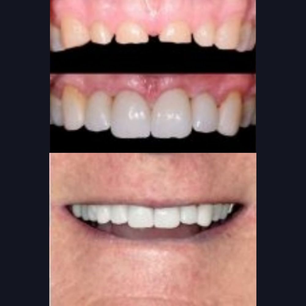 abrasive wear on teeth