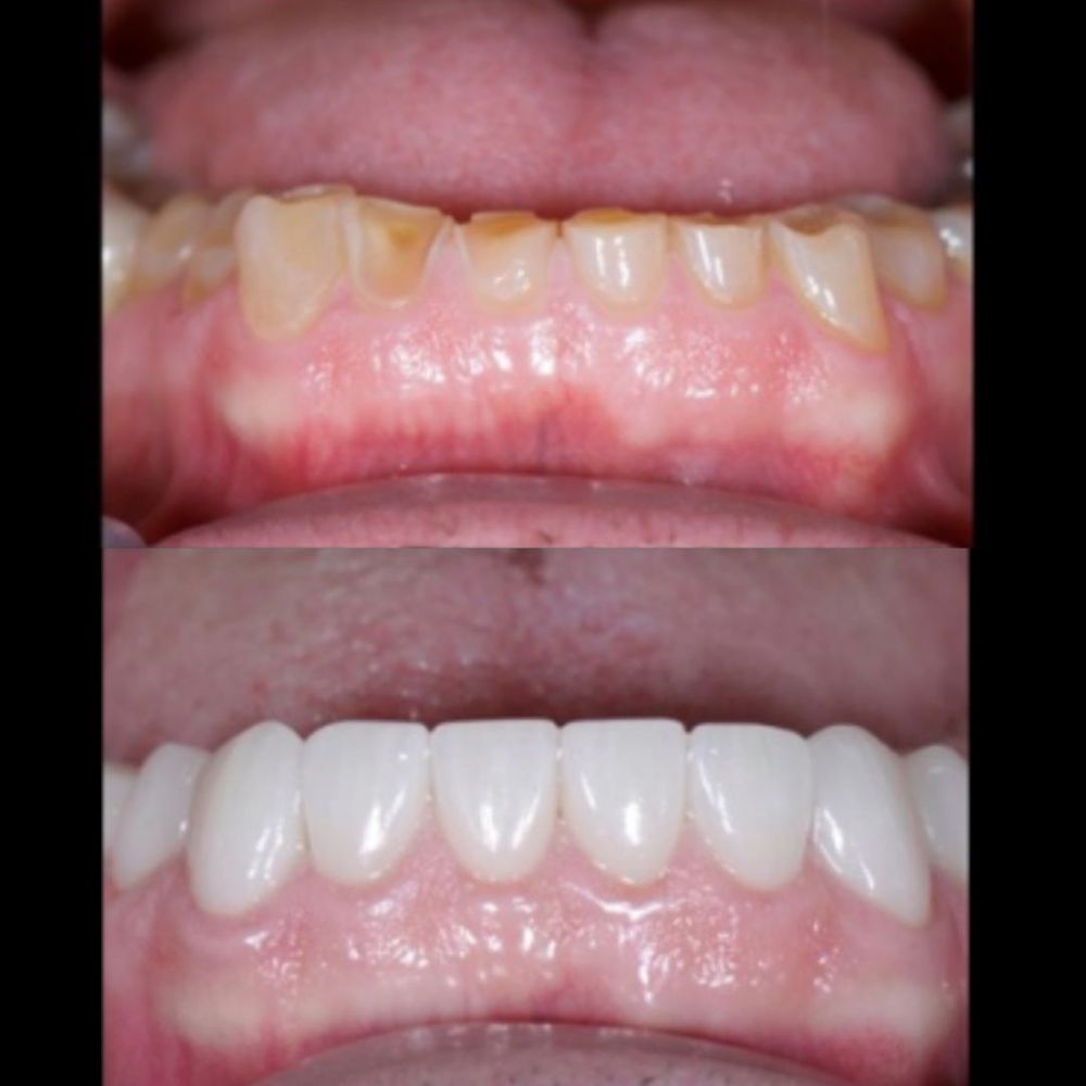 Erosive Wear on teeth