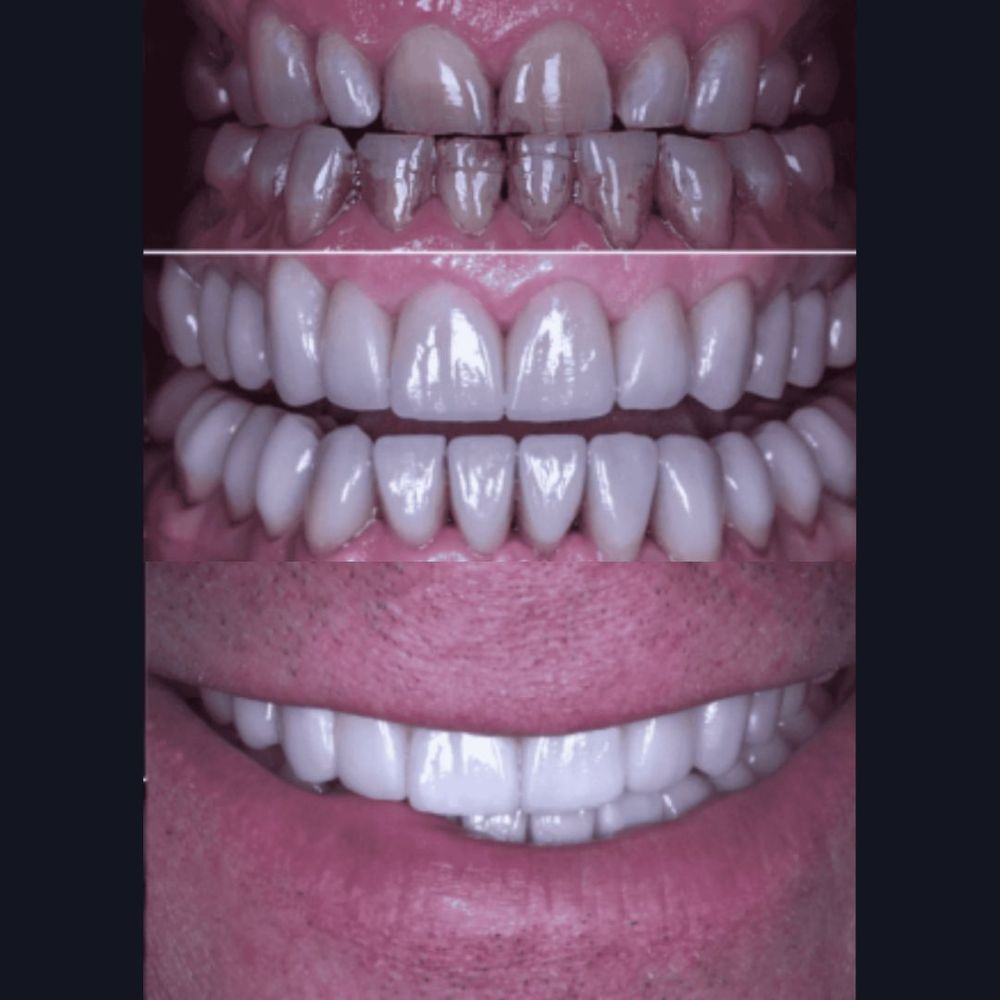 Porcelain Veneers