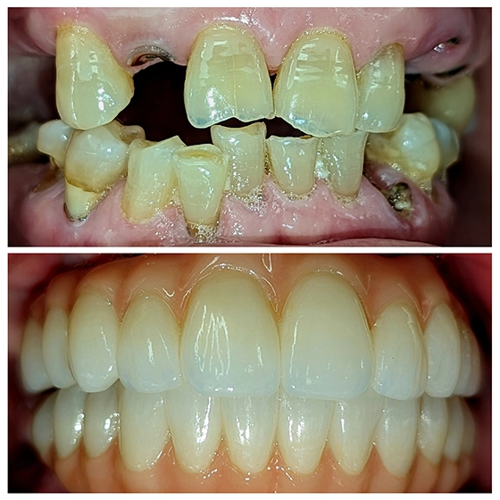 Comparison of teeth before and after dental restoration: upper image showing decayed, broken, and missing teeth; lower image showing a full set of healthy, white, and well-aligned teeth.