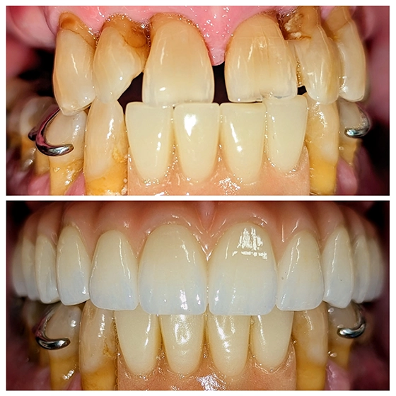 Comparison of teeth before and after dental restoration, showing significant improvement in alignment, color, and shape.