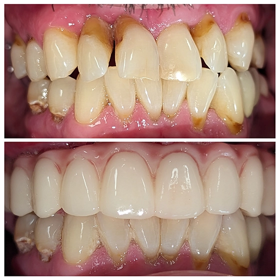 Before and after images of teeth showing significant improvement in color and alignment after dental treatment.