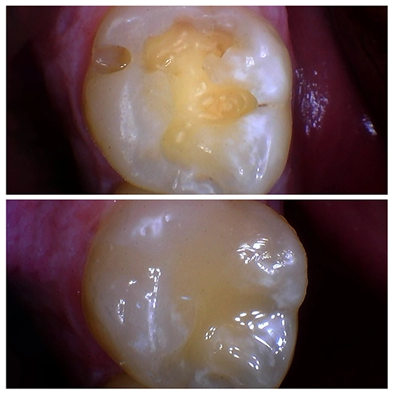 Close-up comparison of a molar tooth before and after dental restoration, showing decay and repaired smooth surface.