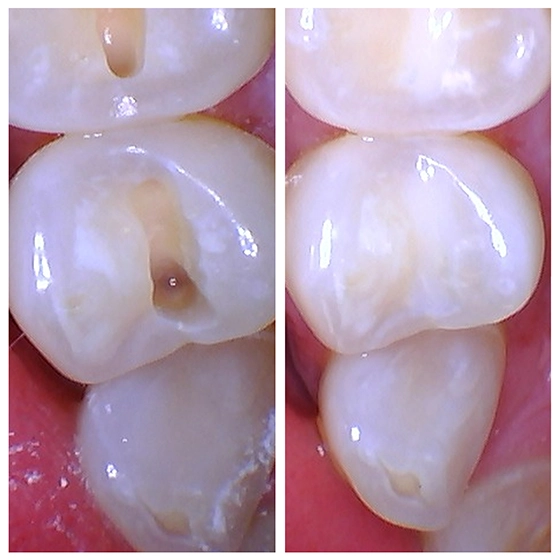 Side-by-side close-up images of a molar tooth showing a cavity before treatment on the left and the same tooth restored after treatment on the right.