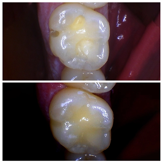 Close-up images showing a human molar tooth before and after dental restoration, highlighting smoother surface and fewer discolorations after treatment.