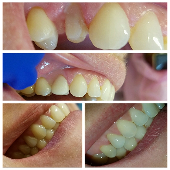 Collage showing close-up views of a person's teeth from different angles, including the upper front teeth and side molars.