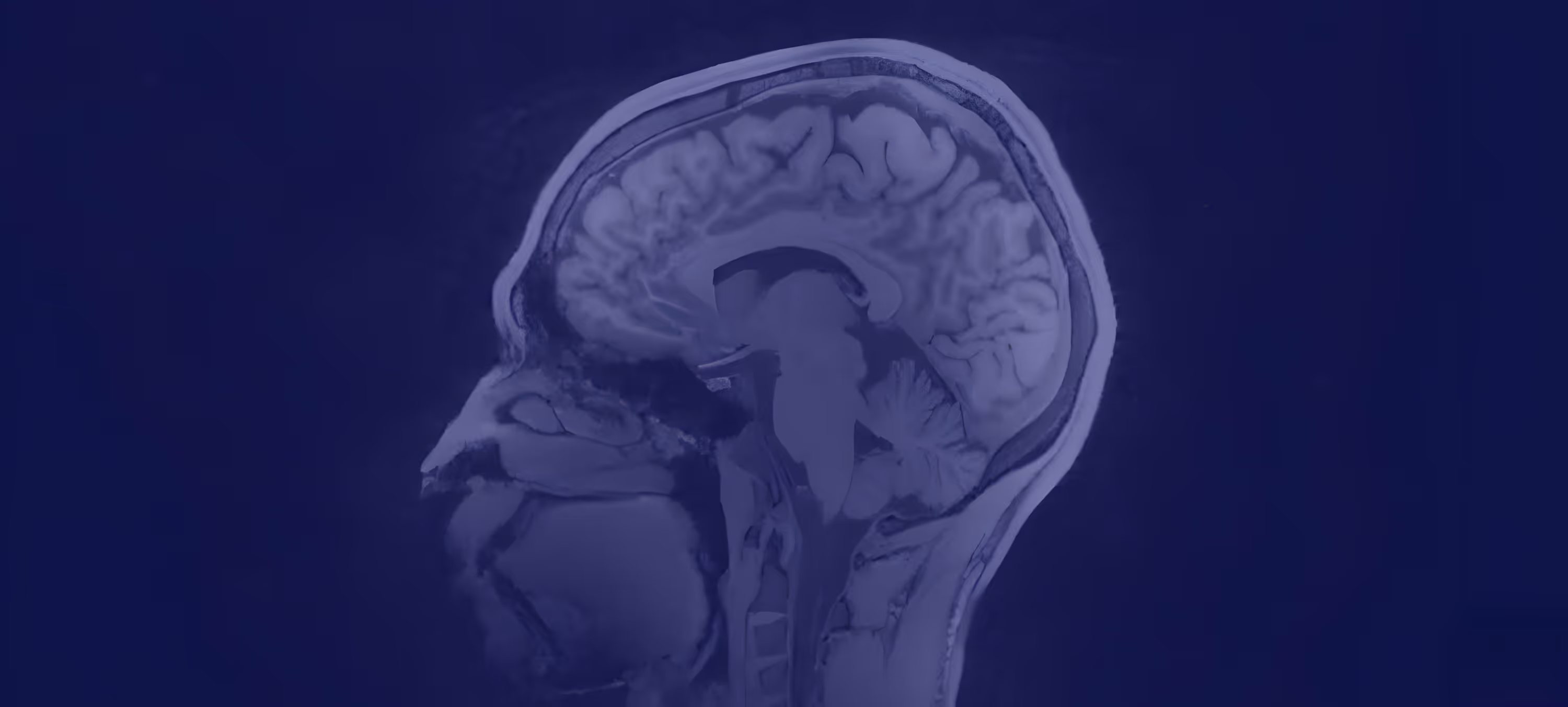 MRI scan showing a sagittal cross-section of a human head highlighting brain structures.