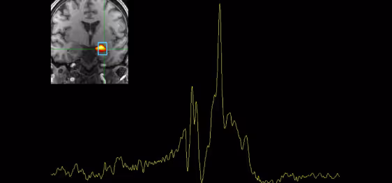 Research scan image of the brain with a region relevant to addiction highlighted, superimposed on a graph of neural activity