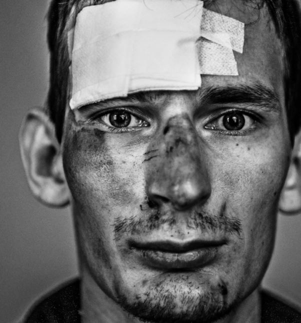 Injured man with bandages and facial bruises.