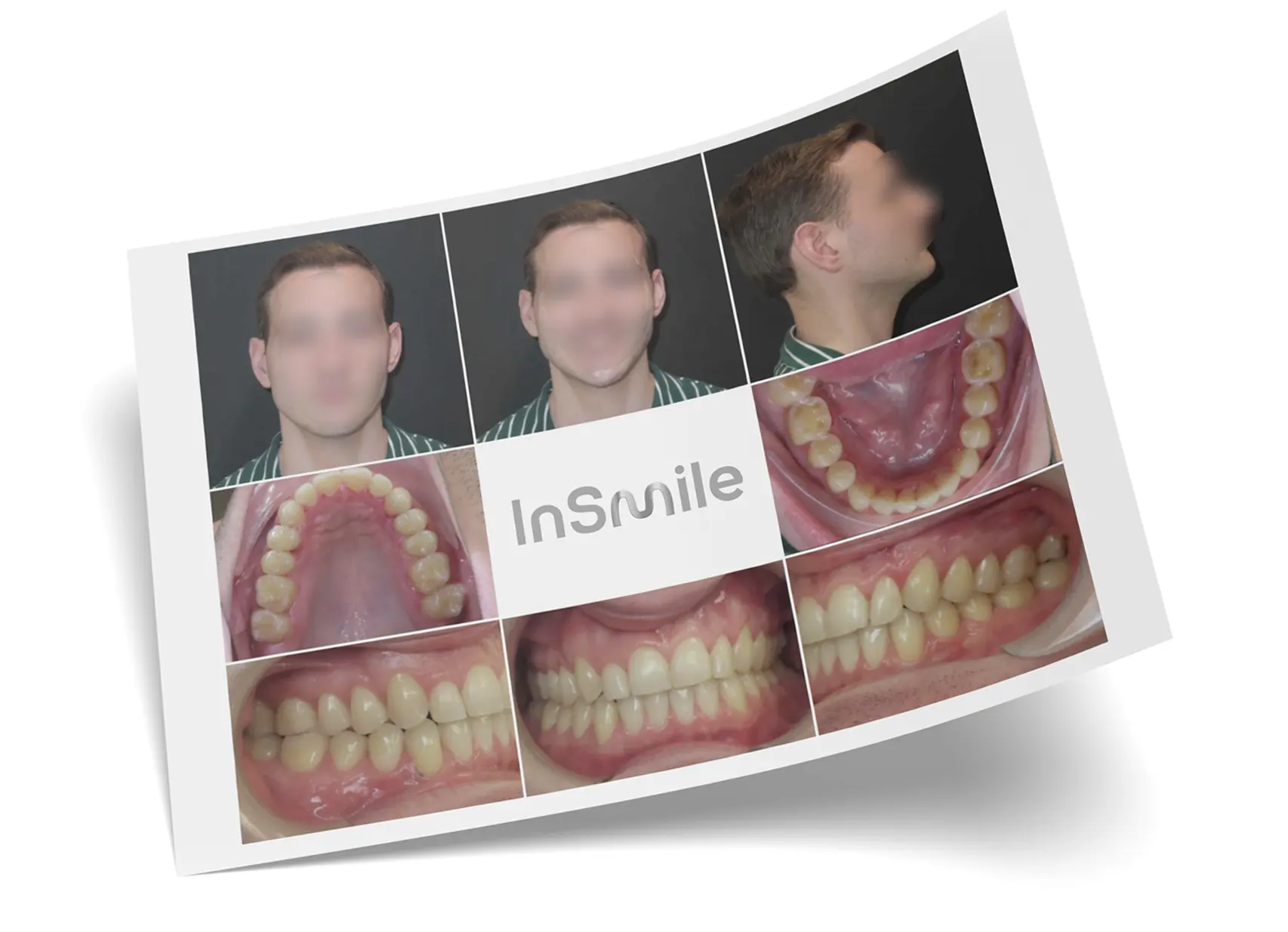 InSmile Braces finished case
