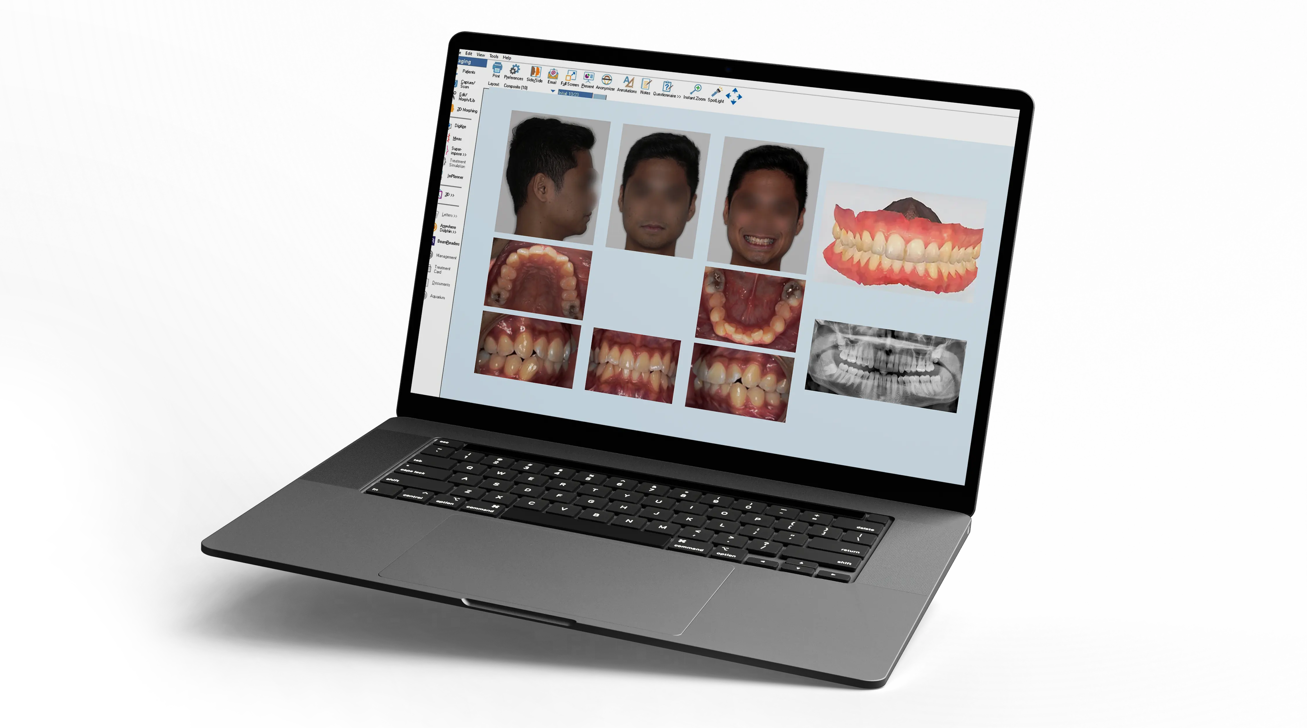 laptop showing orthodontic records