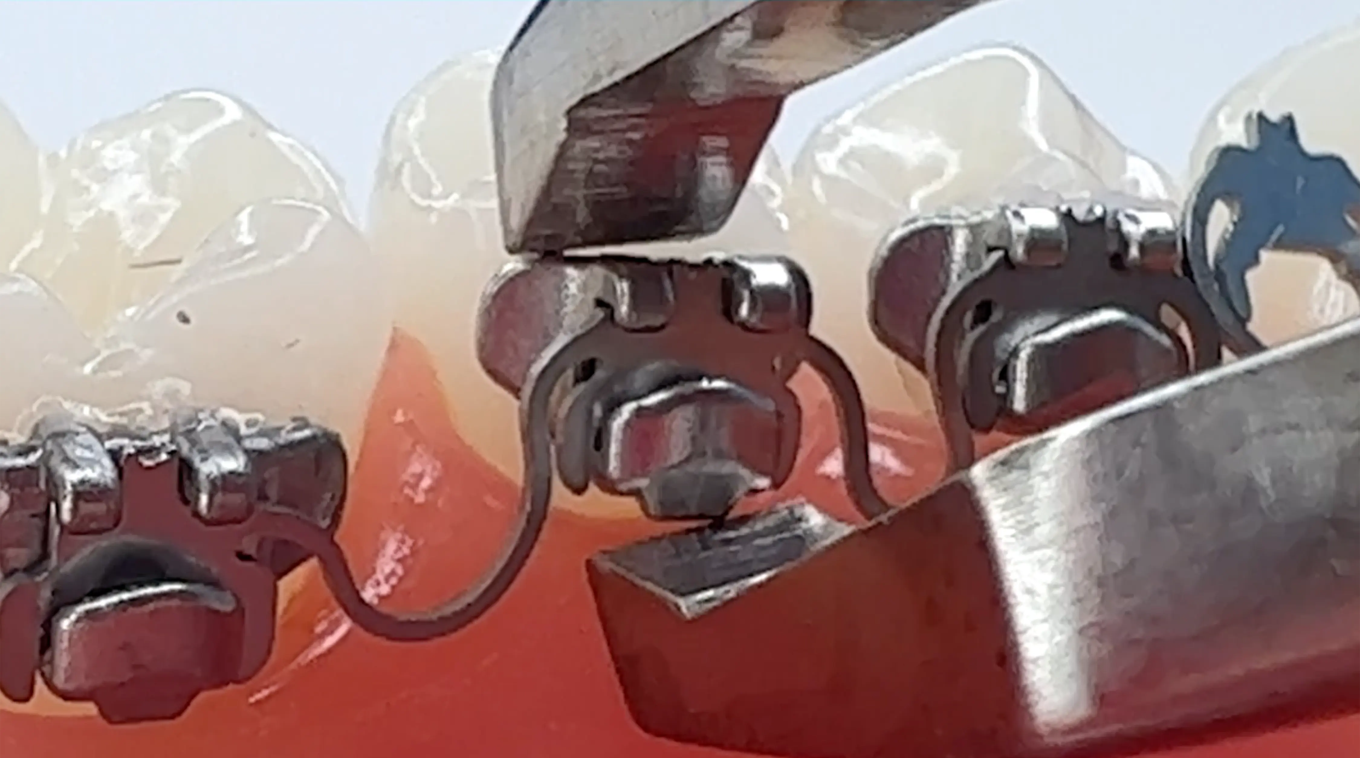 pliers showing removal of InSmile Braces Smartwire