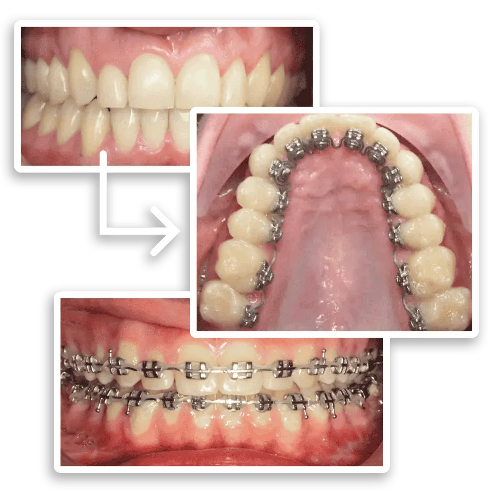 collage showing insmile braces vs traditional braces