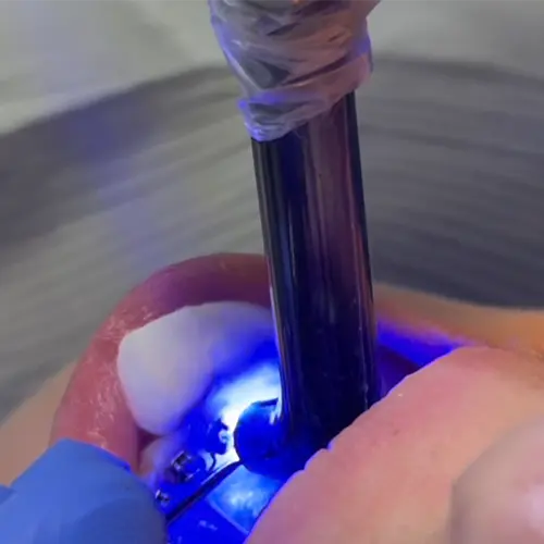 InSmile Brackets being light cured