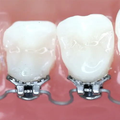 Occlusal view of InSmile Braces