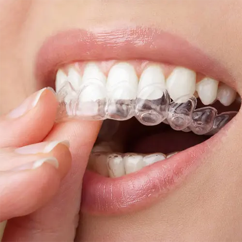 smiling teeth putting in clear retainers