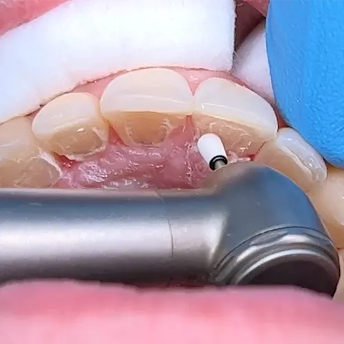 orthodontic handpiece removing glue