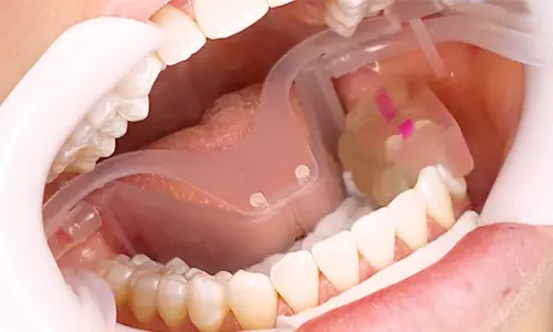 InSmile Braces indirect bonding tray placed in mouth