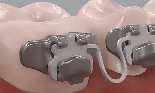 InSmile Braces illustration