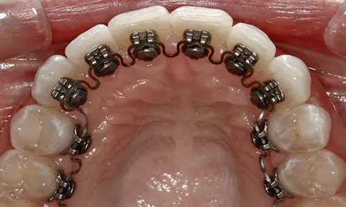 InSmile Braces in occlusal view