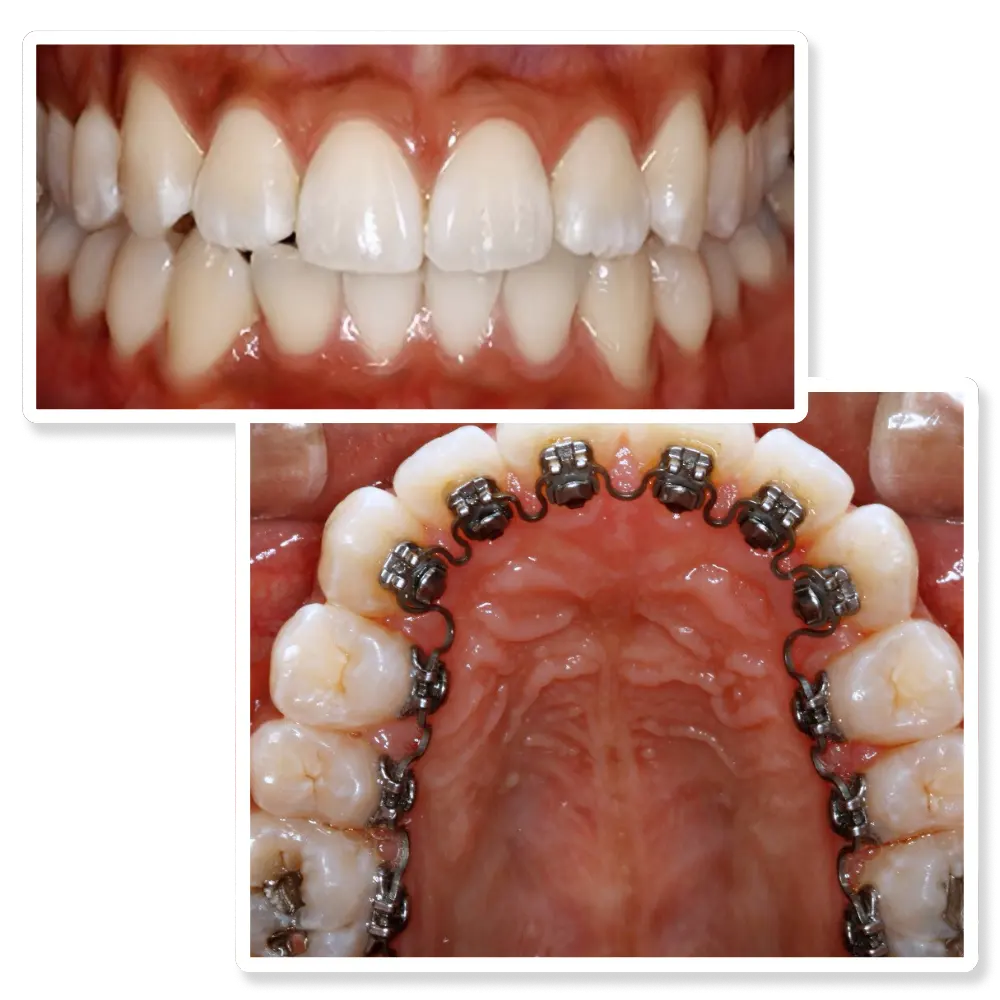 InSmile Braces occlusal view