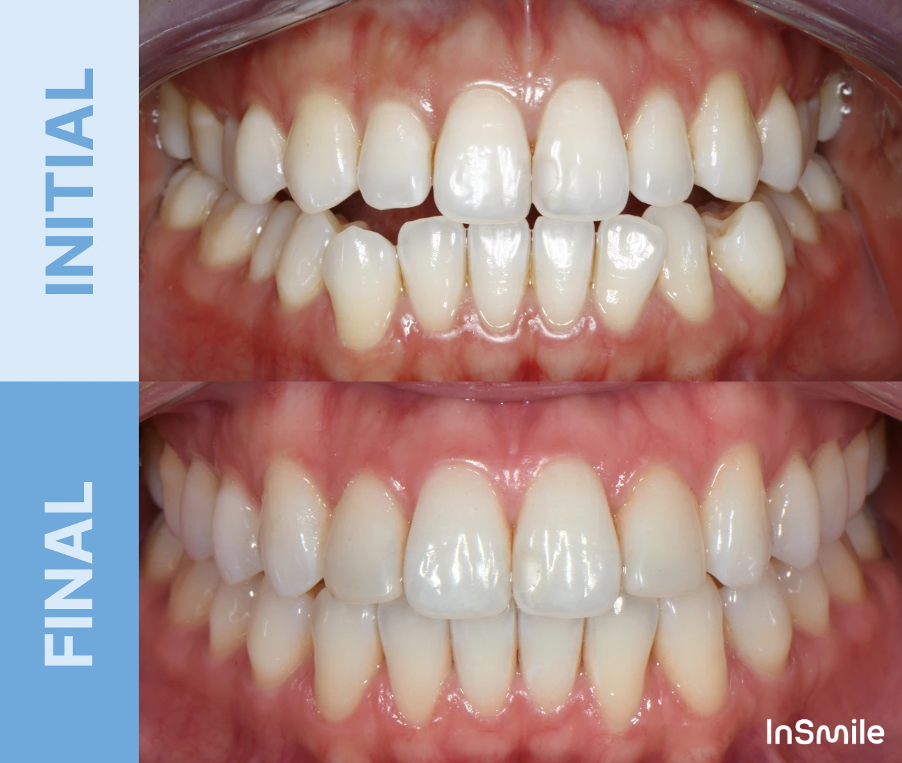 Side-by-side comparison of teeth before and after dental treatment showing improved alignment and whitening.