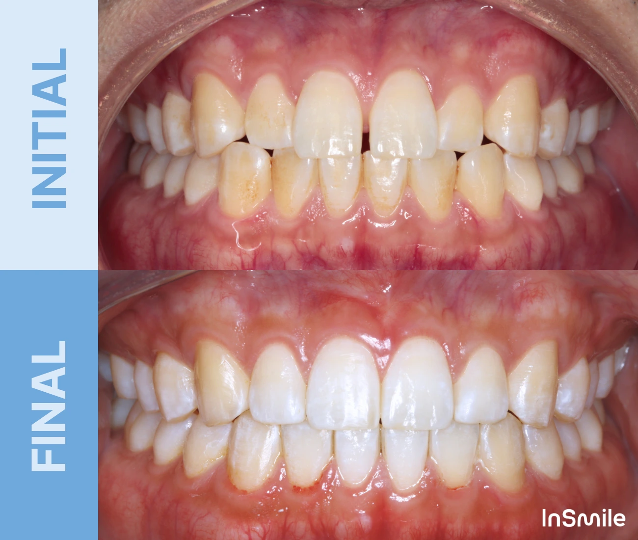 Side-by-side comparison of teeth showing initial stained and discolored teeth and final whiter, cleaner teeth after dental treatment.