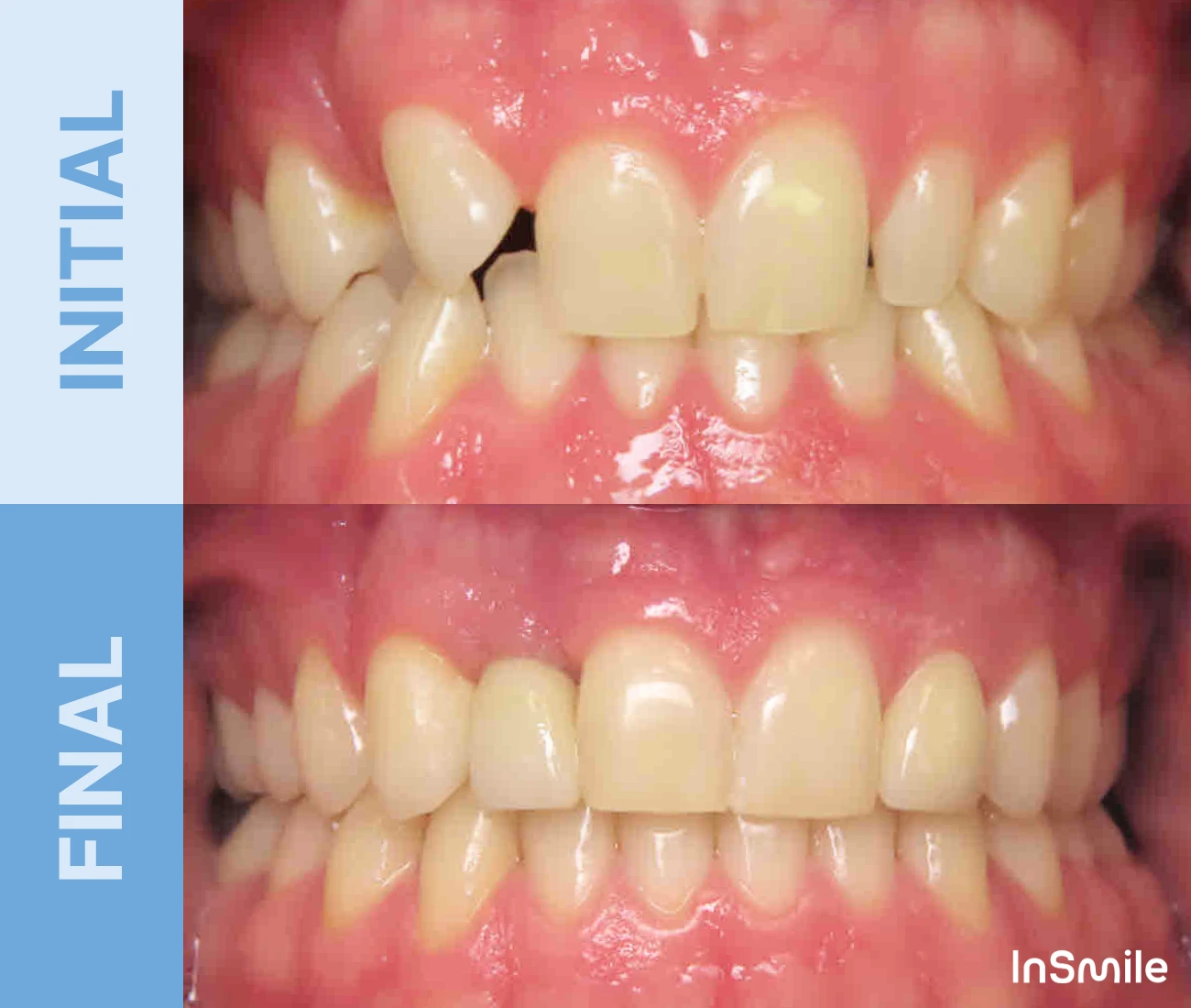 Side-by-side comparison of misaligned teeth before and straightened teeth after orthodontic treatment.