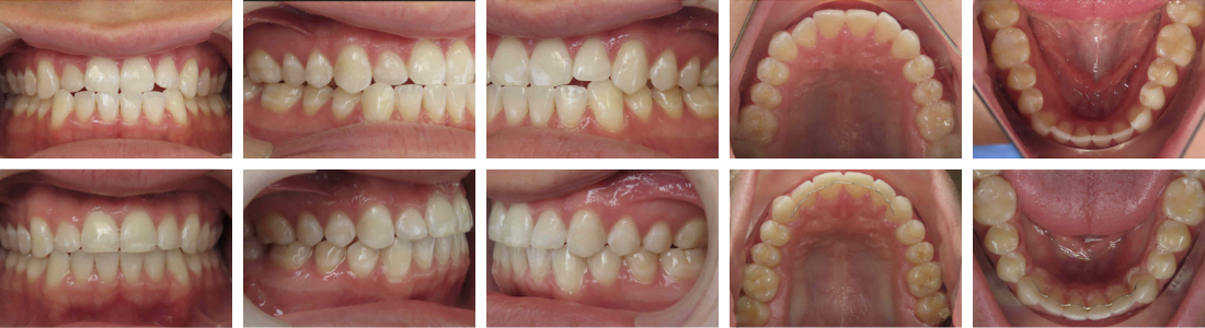 InSmile Braces class 3 results