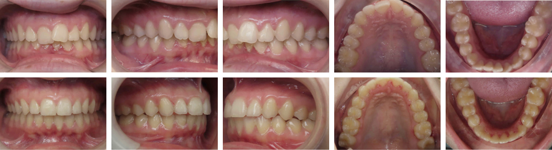 InSmile Braces crowding results
