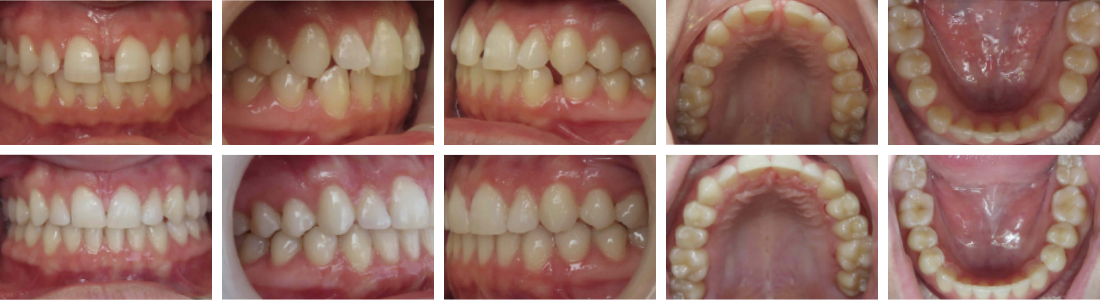 InSmile Braces spacing results