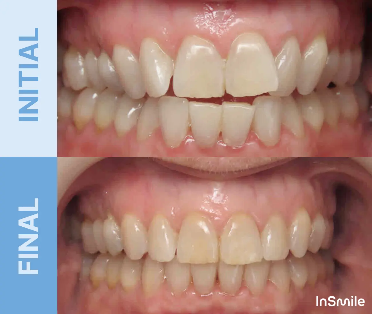 Comparison of teeth showing initial crooked and spaced upper front teeth versus final straighter and aligned teeth after treatment.