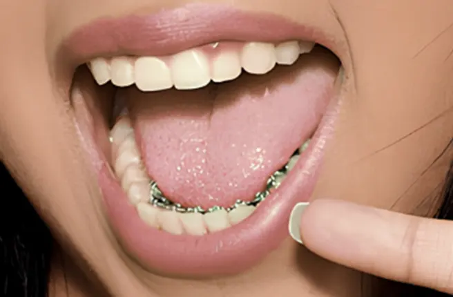 occlusal view of InSmile Braces