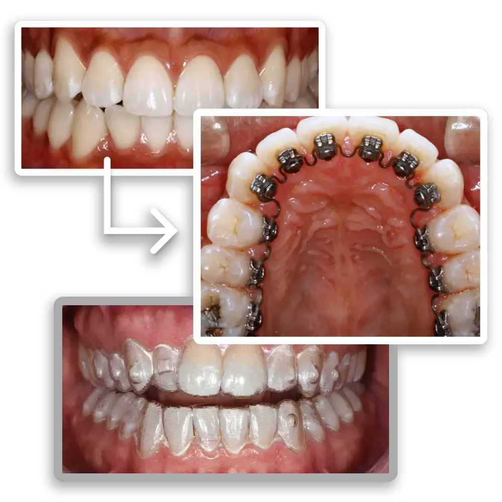 collage showing insmile braces vs clear aligners