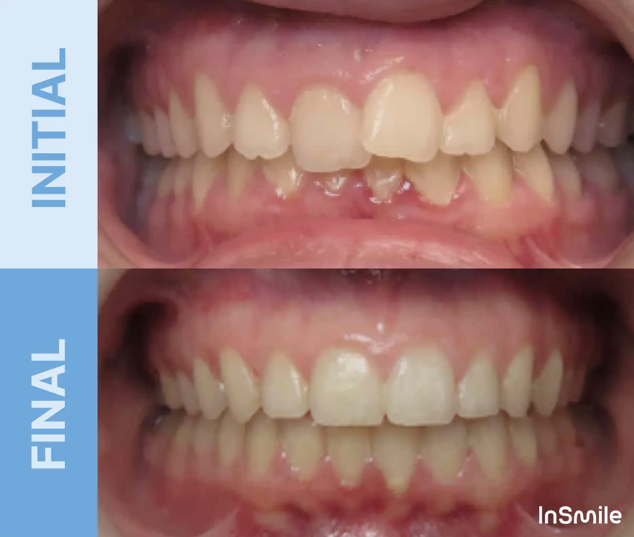 Side-by-side comparison of a person's teeth before and after dental treatment, showing significant improvement in alignment and appearance.