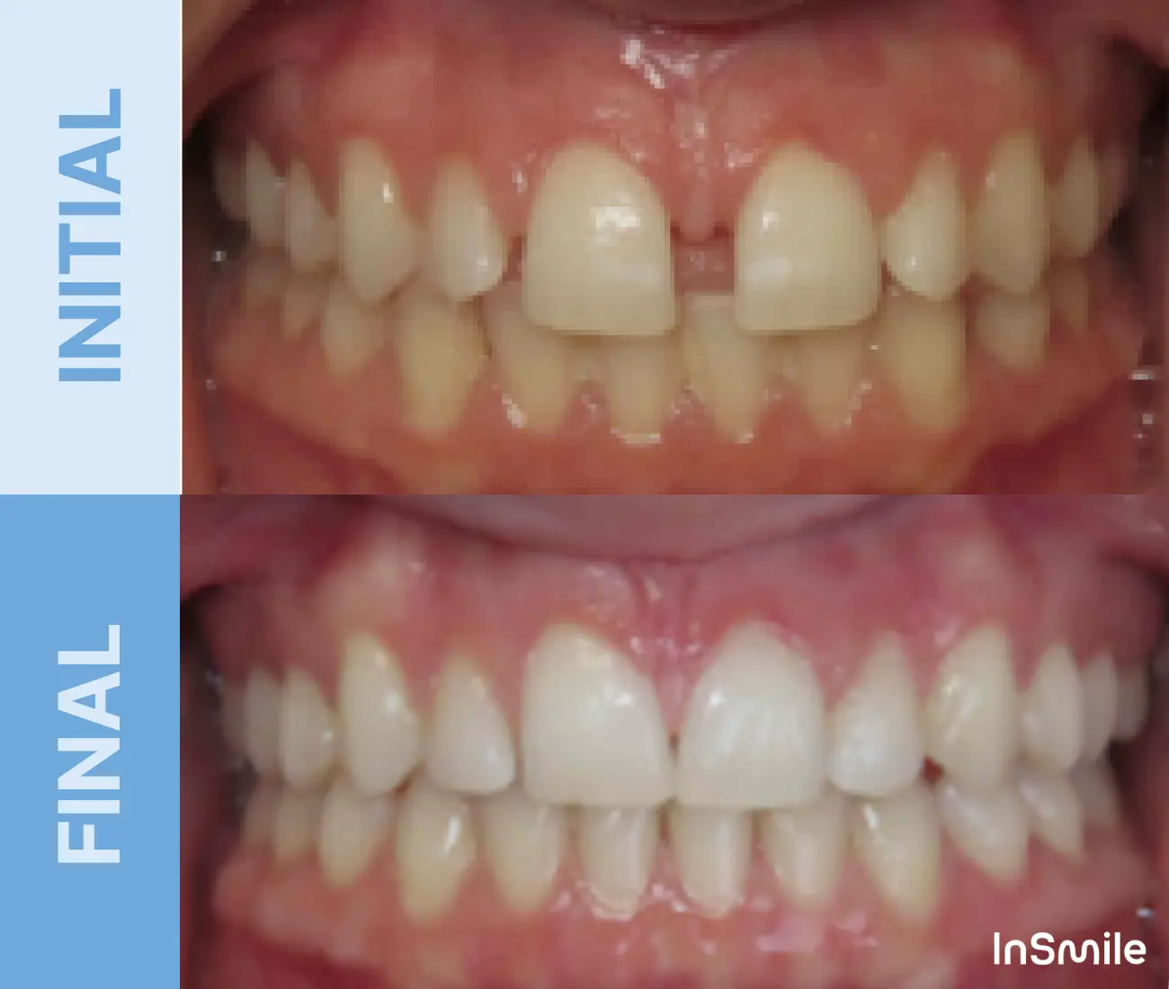 Comparison of teeth before and after dental treatment showing initial gaps and alignment issues corrected in final results.