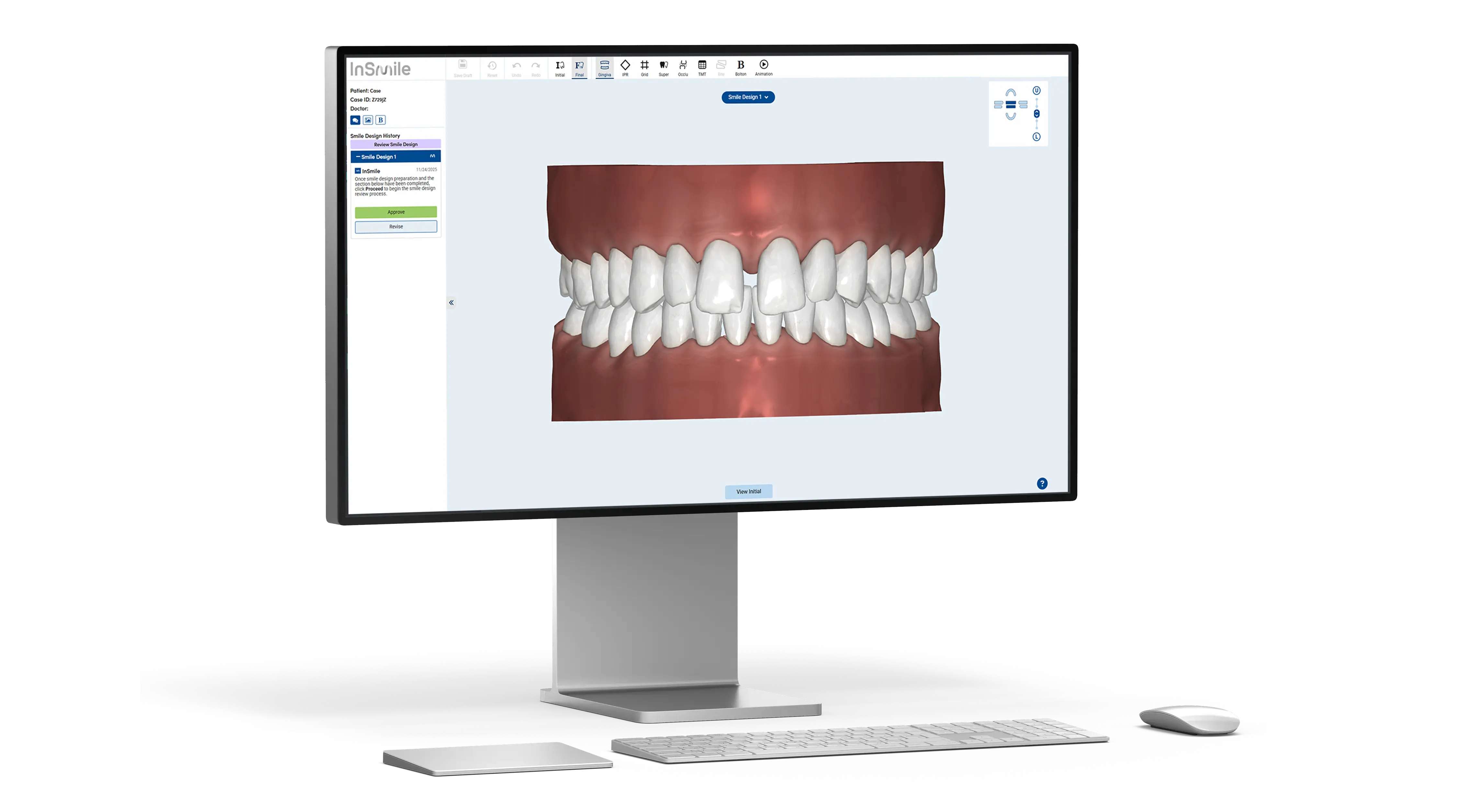computer showing InSmile Braces Smile Design Software