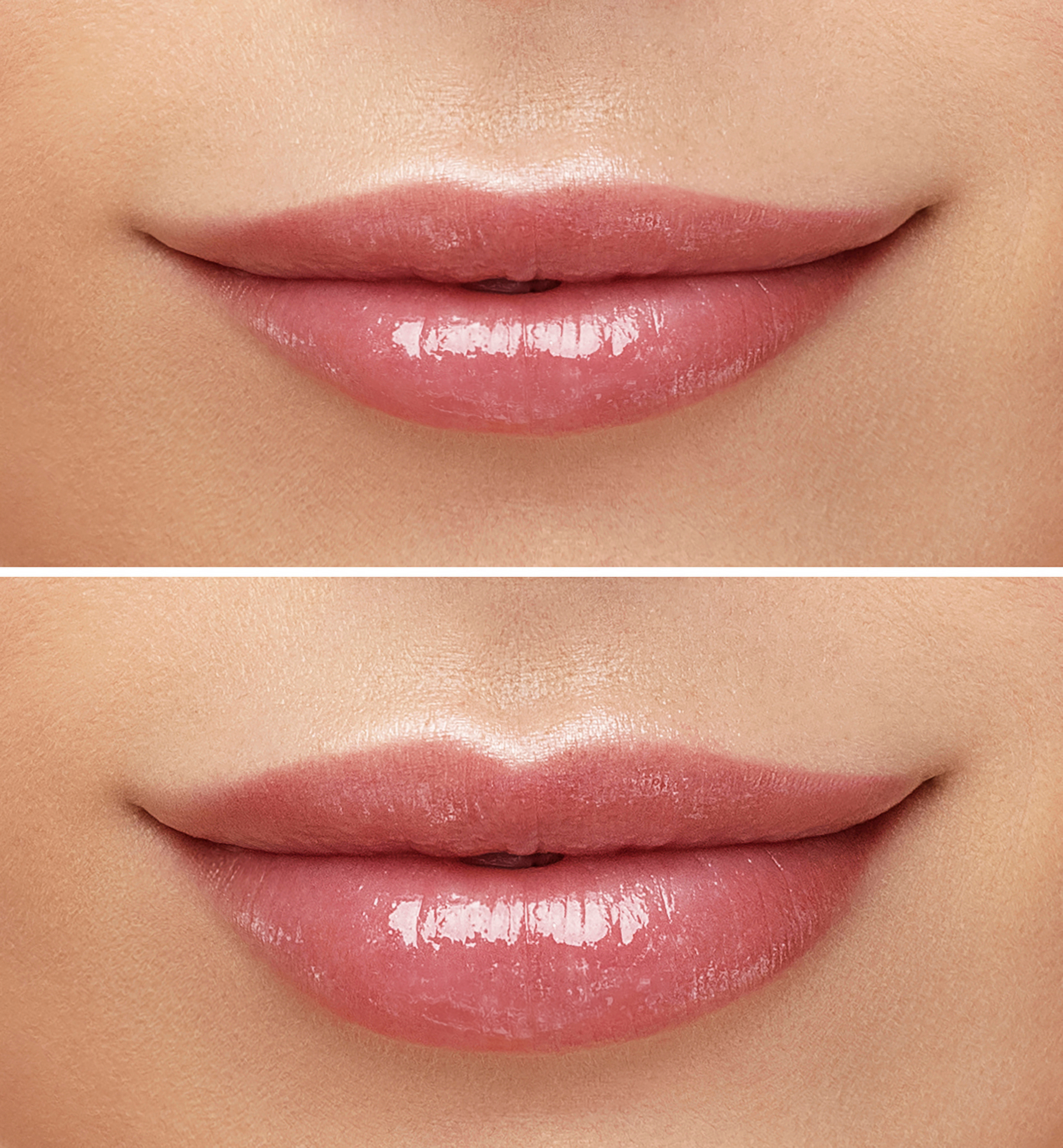 Before and after lip rejuvenation