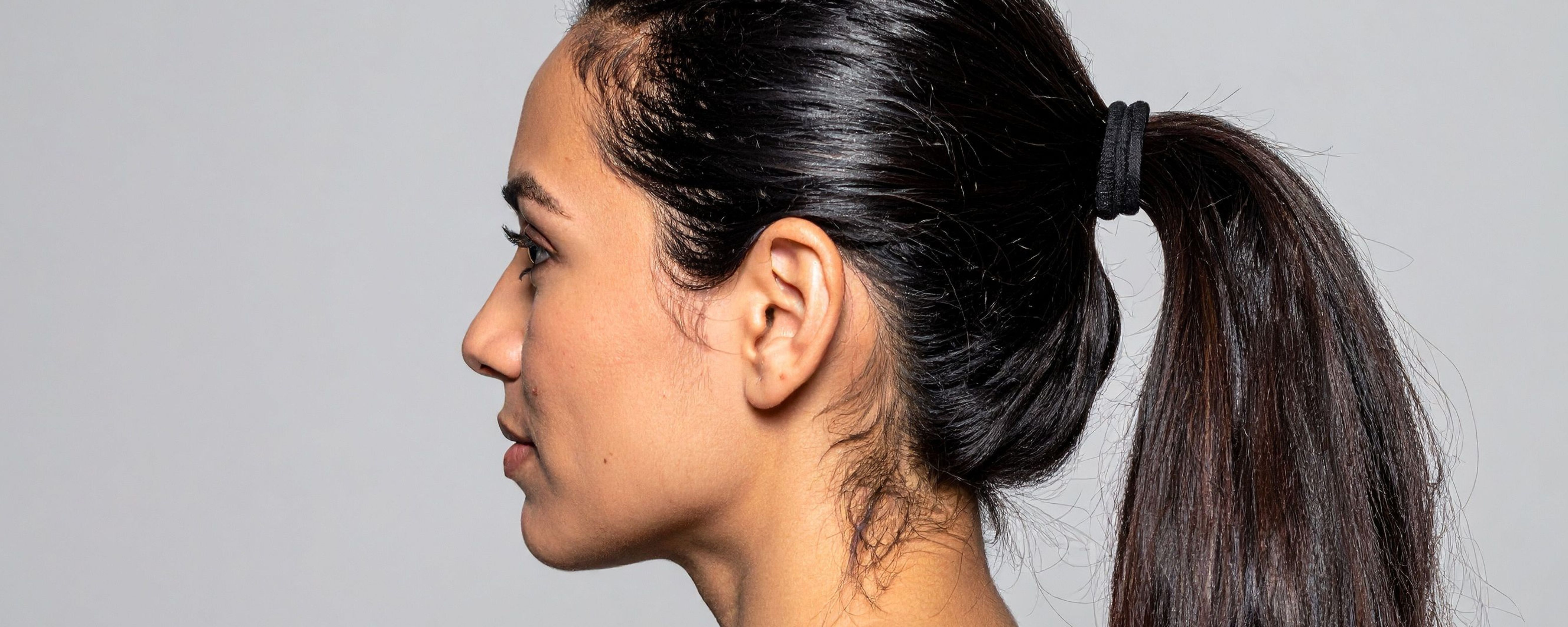 well balanced facial profile after Orthognathic surgery
